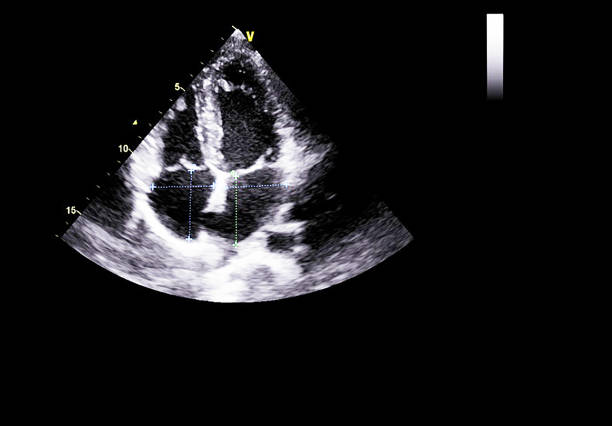 istock Screen of echocardiography (ultrasound) machine. 1181640828