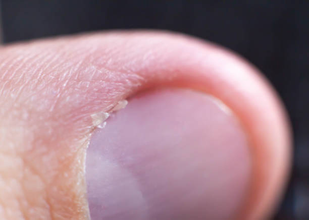 istock Burr and cuticle on a human nail, closeup. Background, macro, fingernail 1181669377