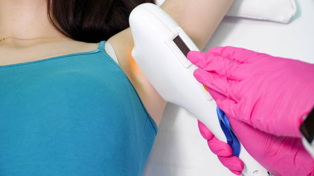 therapist in sterile gloves removes hair on lady armpit - beauty spa flash imagens e fotografias de stock
