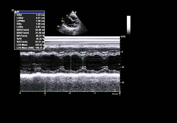 istock Screen of echocardiography (ultrasound) machine. 1181844614