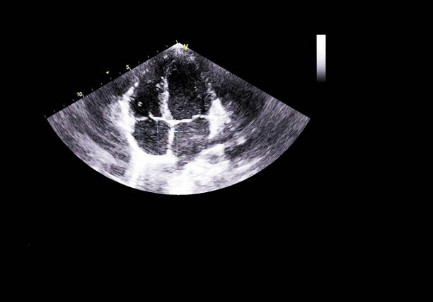istock Screen of echocardiography (ultrasound) machine. 1181844829