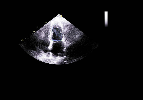istock Screen of echocardiography (ultrasound) machine. 1181844881