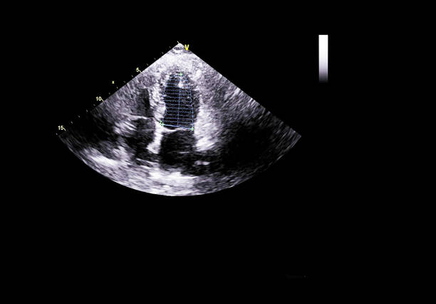 istock Screen of echocardiography (ultrasound) machine. 1181846546
