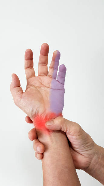 Hand anatomy. The patient suffer from  symptom wrist pain (red highlight), numbness and tingling(blue highlight) from ulnar tunnel syndrome disease(nerve entrapment in Guyon canal). medical problem ulnar tunnel syndrome entrapment stock pictures, royalty-free photos & images