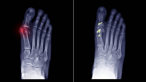 手術前と手術後の比較。フィルムx線足x線写真は、整形骨切り術固定による治療のハルク弁振症またはバニオン病を示す。医療技術の概念 - misalignment ストックフォトと画像