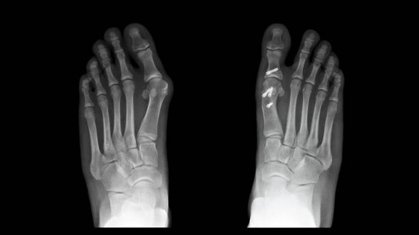フィルムx線足のx線写真は、右側が矯正骨切除術で手術によって治療されたハルックスバルガス変形またはbunion疾患を示す。左側は進行性疾患を示す。医療技術コンセプト - misalignment ストックフォトと画像