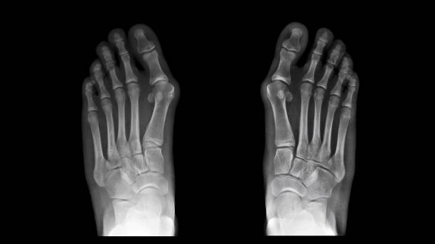 フィルムx線フットレントゲン写真は、ハルクスバルガス変形またはブニオン病の両方を示す。患者は大きなつま先の痛みの症状を持っています。これは、靴の着用と化粧品の問題を引き起こ - misalignment ストックフォトと画像