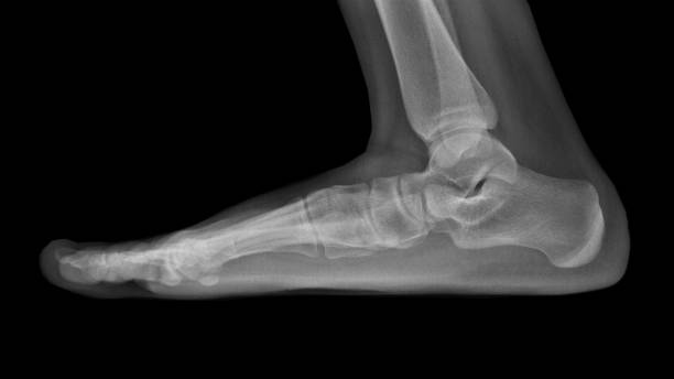 Film X-ray foot radiograph show Flat foot deformity (pes planus or fallen arches) and abnormal union of tarsal bone( Calcaneonavicular coalition). The patient has foot,ankle pain ankle problem Film X ray flat foot deformed stock pictures, royalty-free photos & images