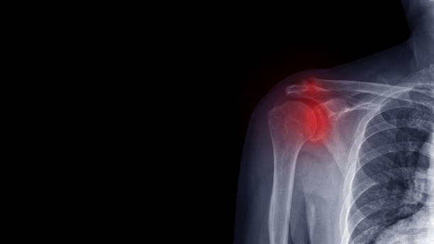 фильм рентгеновский рентгенограмма плеча показывают дегенеративное заболевание остеоартрита гленохумерального и акромиоклавикулярного - rotator cuff стоковые фото и изображения