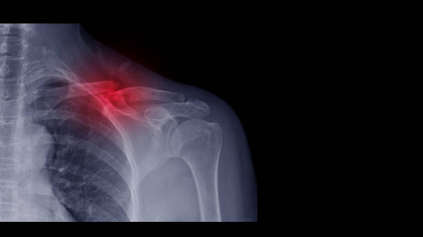 film x-ray shoulder radiograph show collar bone broken (clavicle fracture) from sport injury. highlight on broken bone part and painful area. medical technology and imaging concept. - clavicle imagens e fotografias de stock