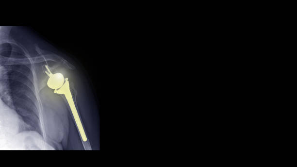 película radiografía hombro muestra prótesis articular. el paciente tiene el desgarro del manguito rotador y el húmero fractura tratado mediante cirugía de reemplazo de hombro (artroplastia de hombro inversa). resalte en el implante médico. - rotator cuff fotografías e imágenes de stock