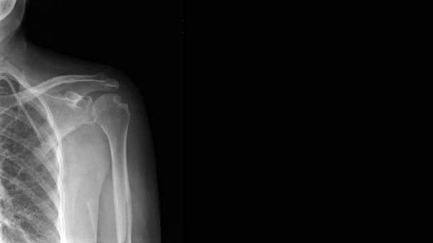 film x ray épaule montrent hill-sachs lésion. la lésion de sachs de colline est la rupture humeral postérieure de compression de tête de l'impaction sur la jante de glenoid après que l'épaule soit disloquée. concept d'imagerie médicale - x ray x ray image shoulder human arm photos et images de collection