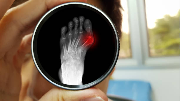 la mano del medico ortopedico che tiene la lente ingrandita e la sua pellicola riflessa radiografia a raggi x della deformità di hallux valgus o malattia di bunion. il paziente ha il problema del dolore. concetto medico - misalignment foto e immagini stock