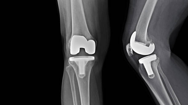Film X-ray knee radiograph showing degenerative osteoarthritis (OA knee disorder) treated by total knee replacement surgery ( TKR ) or joint prosthesis and free copy space. Medical technology concept. Film x ray total knee replacement surgery artificial knee photos stock pictures, royalty-free photos & images