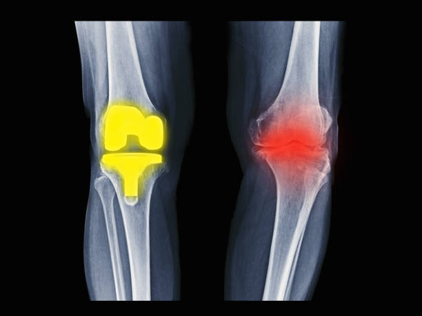 Film X-ray knee radiograph showing bilateral degenerative osteoarthritis (OA knee). Right side treated by total knee replacement(TKR) or joint prosthesis. Left showing progressive disease. Film X ray: right knee total knee replacement surgery, Left knee osteoarthritis disease artificial knee photos stock pictures, royalty-free photos & images