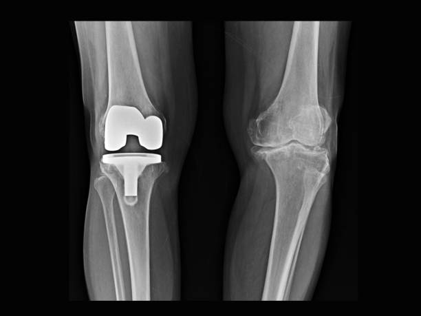film x-ray knee radiograph showing bilateral osteoarthritis disease (oa knee). right side treated by total knee replacement(tkr) or joint prosthesis. left showing progressive disease. - human joint human knee pain x ray imagens e fotografias de stock
