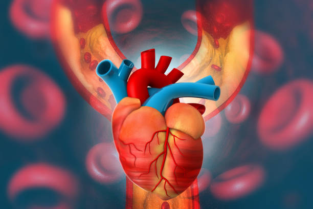 istock Cholesterol plaque in artery with Human heart anatomy 1182014647