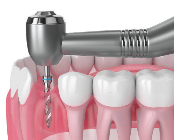 istock 3d render of jaw with gum drilling 1182015906