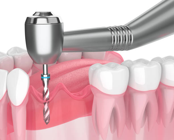 istock 3d render of jaw with gum drilling 1182015913