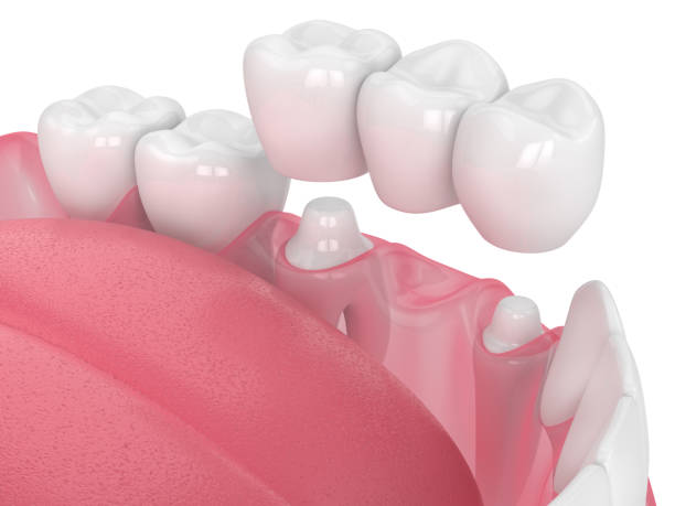 3d render de mandíbula con puente dental - corona-dental fotografías e imágenes de stock