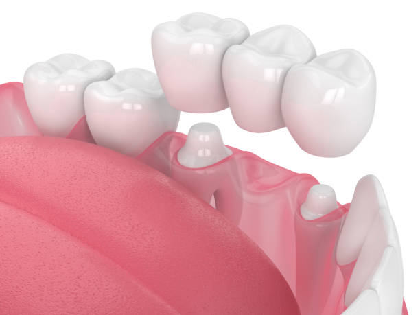 3d render of jaw with dental bridge 3d render of jaw with dental bridge  over white background dental crown stock pictures, royalty-free photos & images