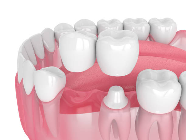 istock 3d render of jaw with dental cantilever bridge 1182015919