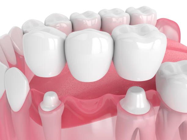istock 3d render of jaw with dental bridge 1182015920