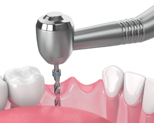 istock 3d render of jaw with gum drilling 1182015935