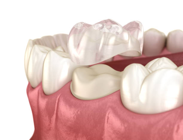 istock Preparated molar tooth for dental crown placement. Medically accurate 3D illustration 1182027622