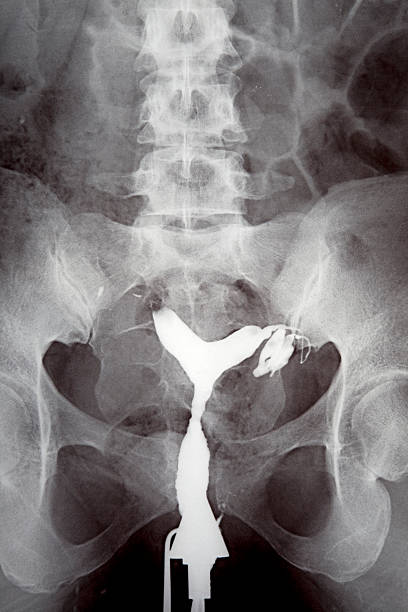 istock Hysterosalpingography Of Uterus 118204964