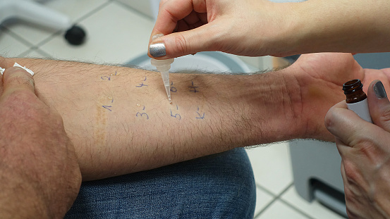Skin Allergy Test. The nurse holds in one hand a bottle with an allergen and drops the drug on a man\