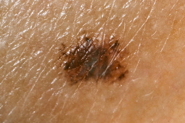 Skin melanoma 5x magnification stock photo