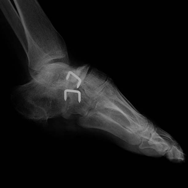 menschlicher fuß x-ray - bending human foot ankle x ray image stock-fotos und bilder