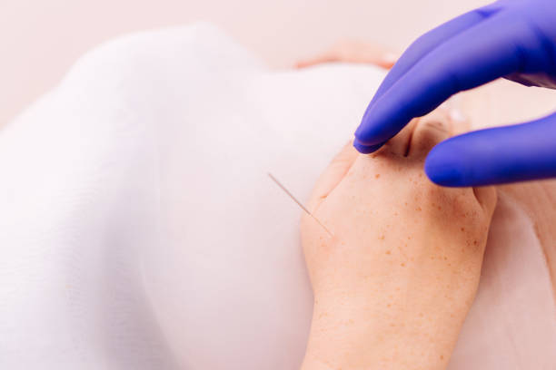 istock Young woman getting acupuncture treatment 1182214797