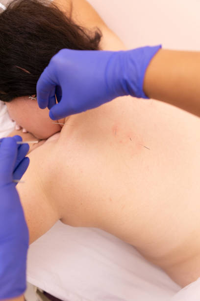 istock female back with needles, procedure of acupuncture 1182214827