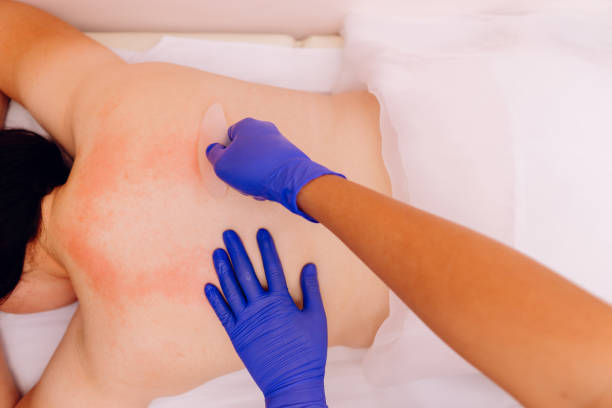 Close-up of a patient undergoing cupping therapy, showing circular marks on their back