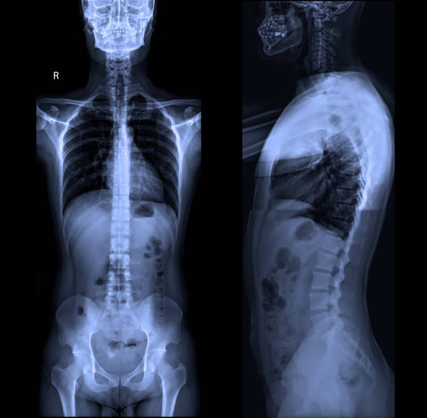 röntgenaufnahme der gesamten wirbelsäule ap & lateral position im dunklen hintergrund. - operative stock-fotos und bilder