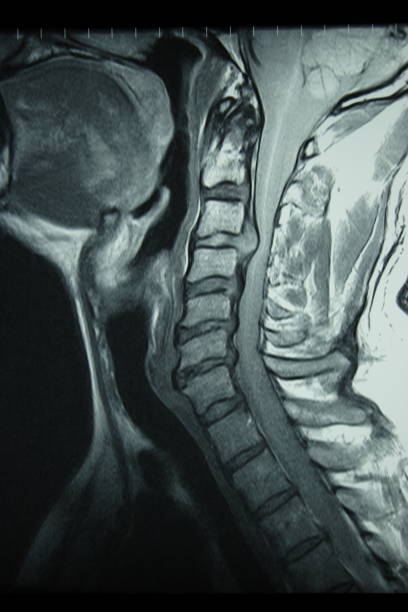 Magnetic Resonance Imaging Scan of the Cervical Spine Showing Herniated ...