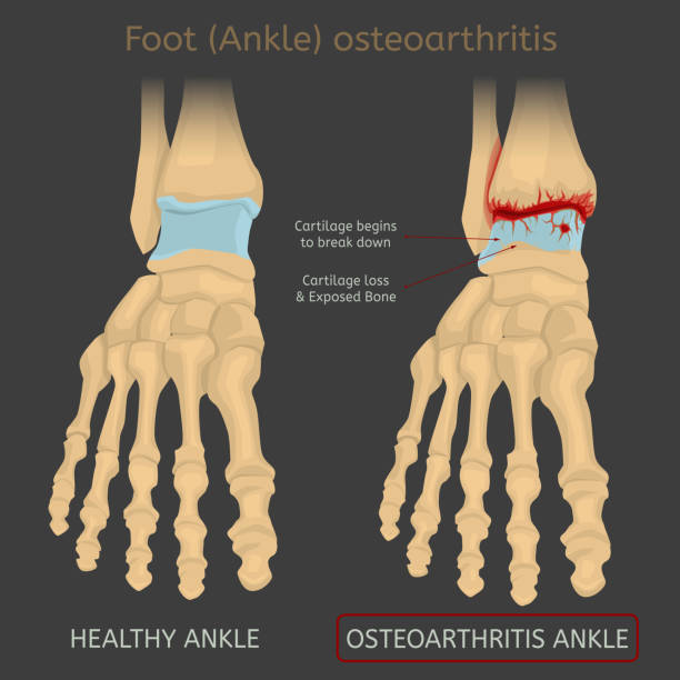 Foot arthritis image Foot arthritis image. Ankle osteoarthritis. Joint pain in human feet. Editable vector illustration in realistic colors on dark background. Medical scheme. Educational poster. Medicine science concept foot injury drawings stock illustrations