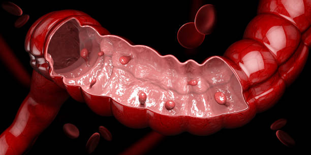 3d illustration of Colon polyps. Polyp in the intestine. isolated black.. 3d illustration of Colon polyps. Polyp in the intestine. isolated black colon stock pictures, royalty-free photos & images