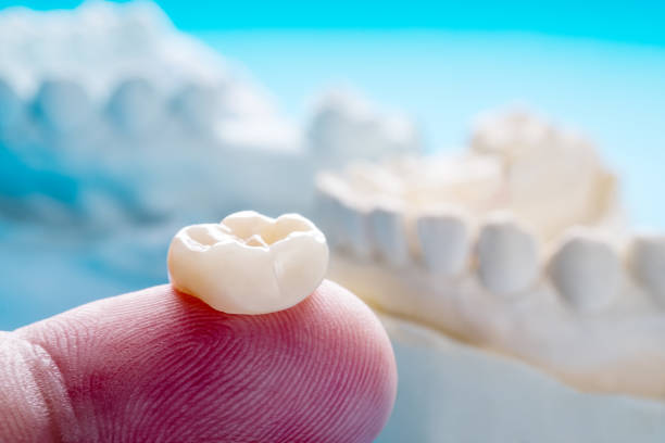 Prosthodontics or Prosthetic Closeup / Prosthodontics or Prosthetic / Single teeth crown and bridge equipment model express fix restoration. dental crown stock pictures, royalty-free photos & images