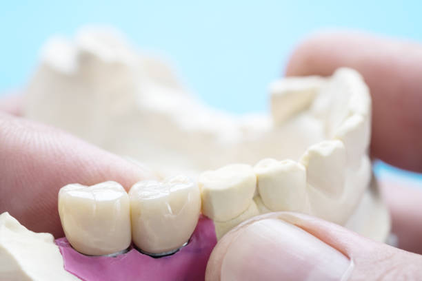 istock Implant Prosthodontics or Prosthetic 1182396027