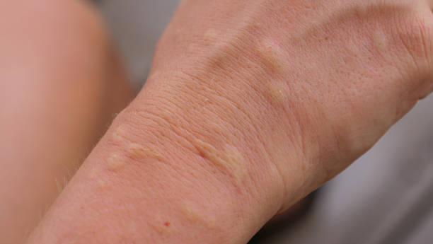 istock MACRO: Unrecognizable woman's arm is filled with nagging swollen mosquito bites. 1182420030