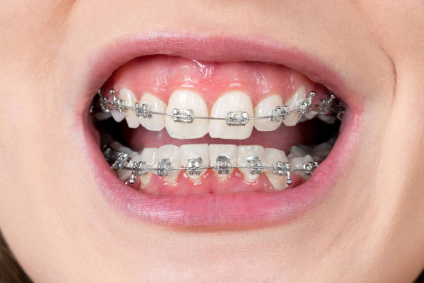 istock Female open mouth showing metal braces 1182434268