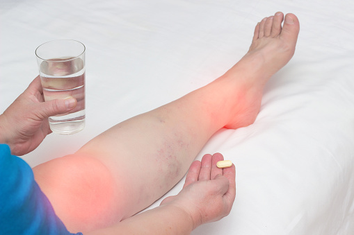 A woman whose leg pain in the joints holds a pill and a glass of water. The concept of treatment of arthritis and arthrosis with anti-inflammatory drugs, vitamins and chondroprotectors, close-up