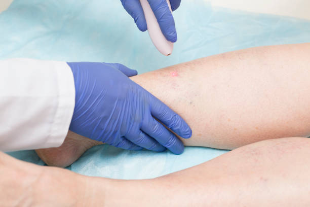 specialist doctor conducts endovenous laser coagulation of the veins of the lower extremities. the concept of treatment for varicose veins and thrombosis - animal vein fotos imagens e fotografias de stock