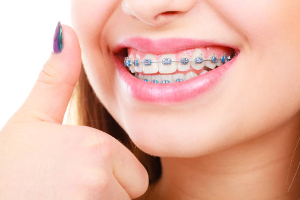 istock Woman showing her teeth with braces 1182495224