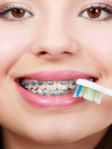 istock Woman brushing teeth with braces using brush 1182495740