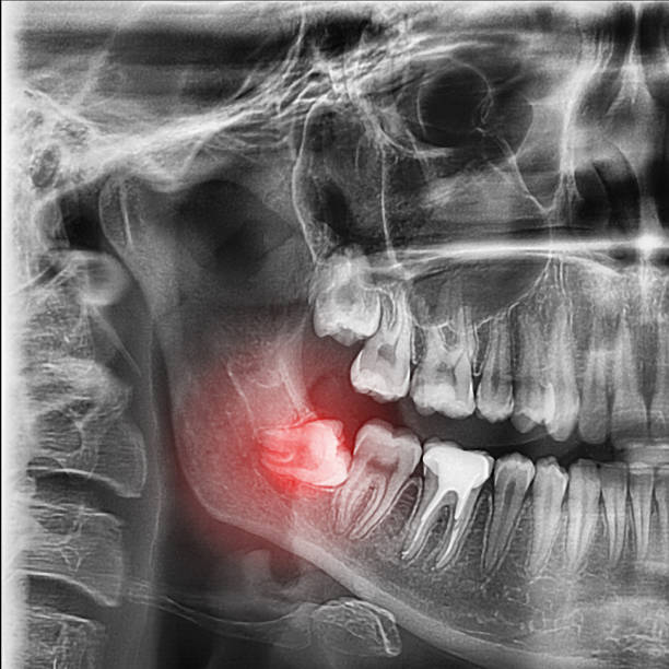 radiographs of the teeth stock photo