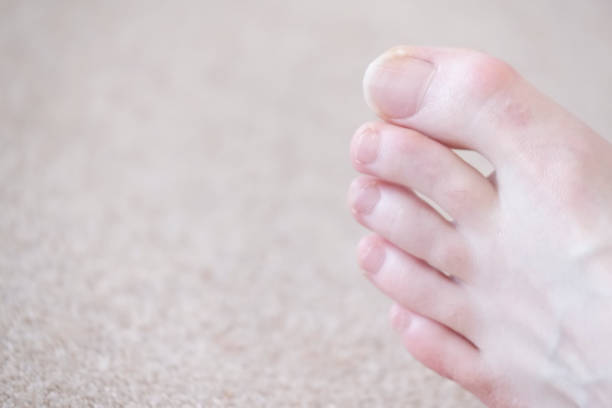 istock Toes and toenails closeup on barefoot at chiropody 1182514516